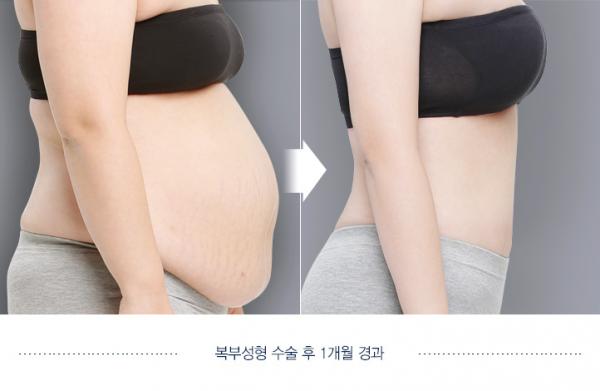 디에이 지방흡입