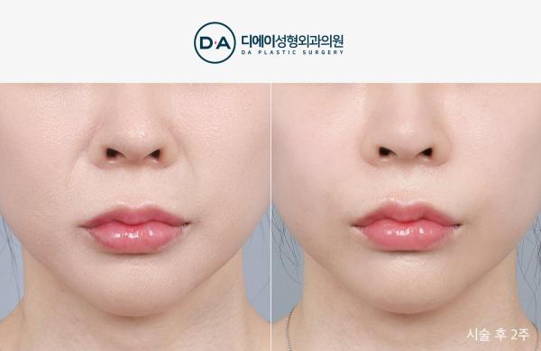 팔자특화 실리프팅