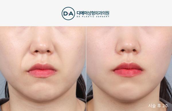 팔자특화 실리프팅