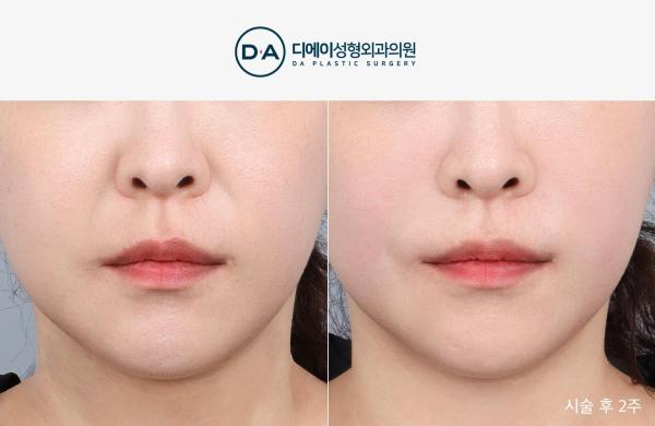 팔자특화 실리프팅