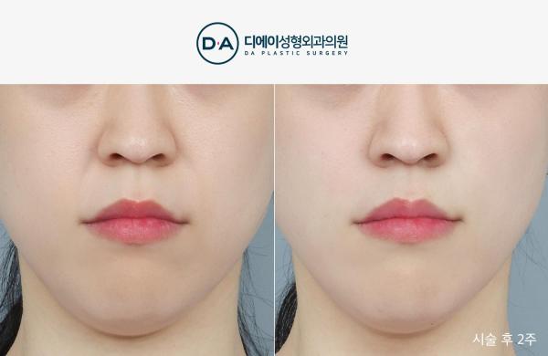 팔자특화 실리프팅