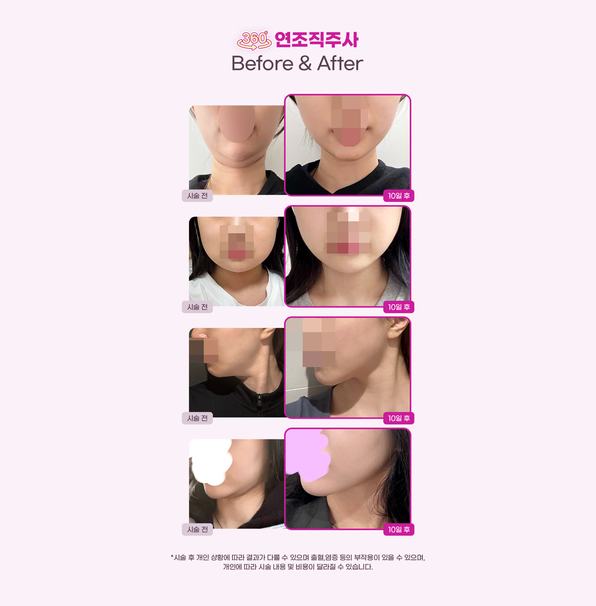 DA어플주사