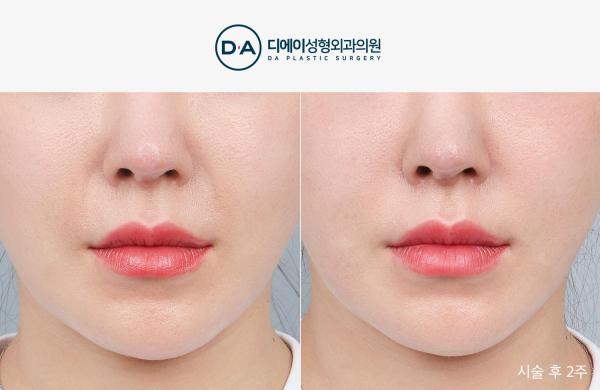 팔자특화 실리프팅