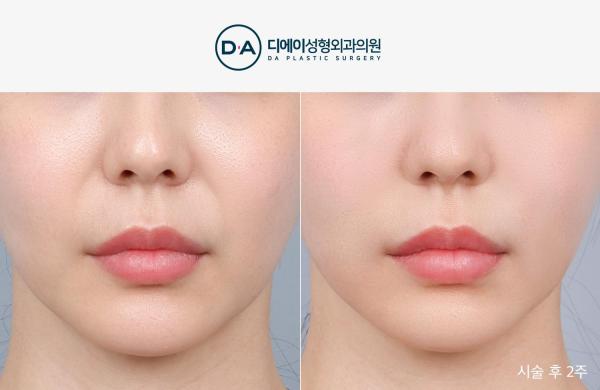 팔자특화 실리프팅